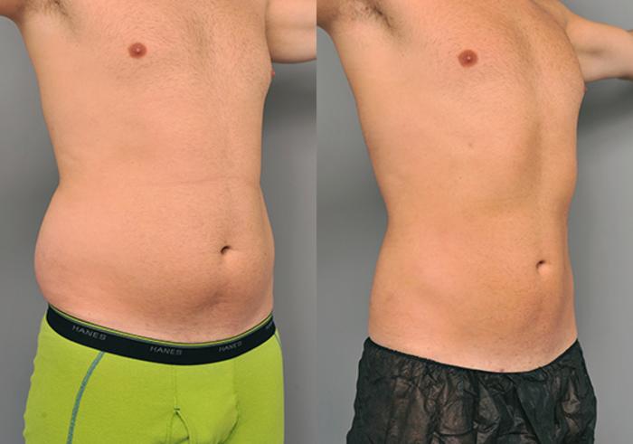 Before & After Liposuction for Men Case 214 View #3 View in New York, NY