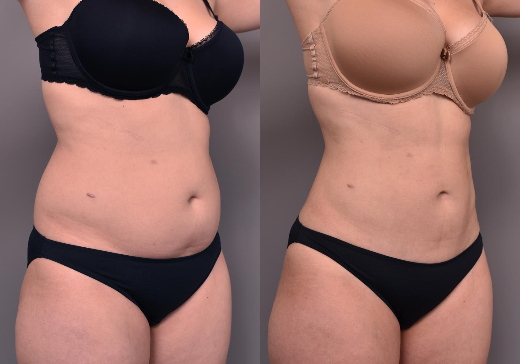 Before & After Liposuction Case 230 View #1 View in New York, NY
