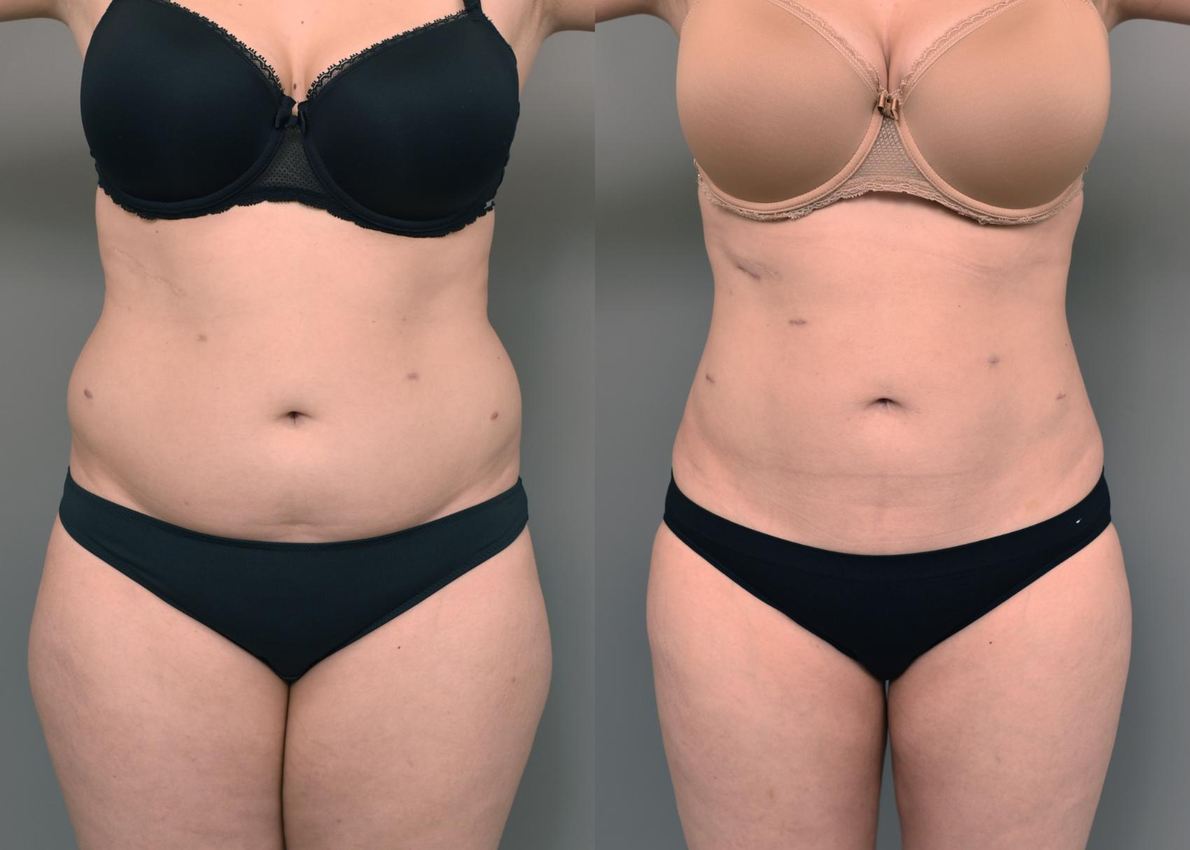 Before & After Liposuction Case 230 View #2 View in New York, NY