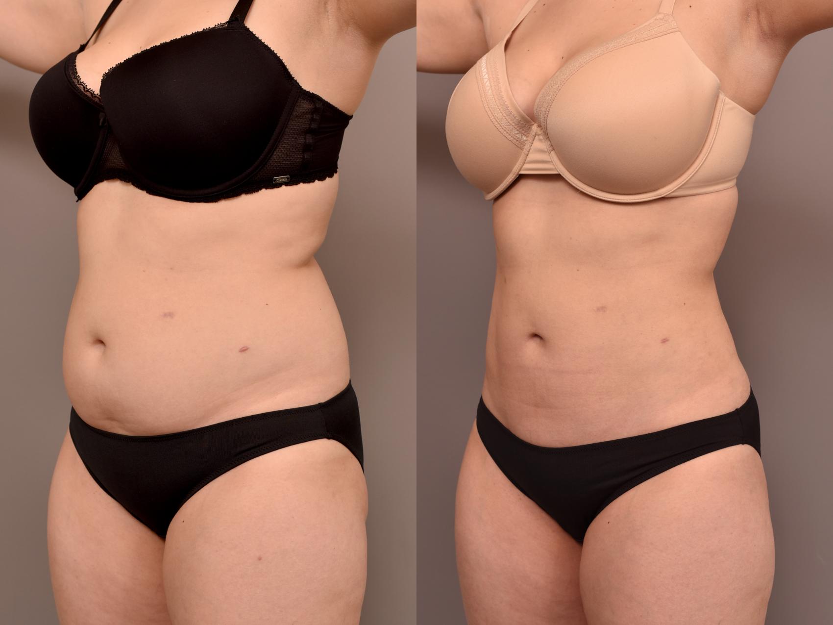Before & After Liposuction Case 230 View #3 View in New York, NY