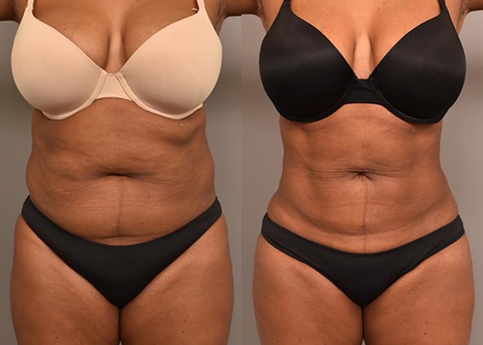 Before & After Liposuction Case 232 View #1 View in New York, NY