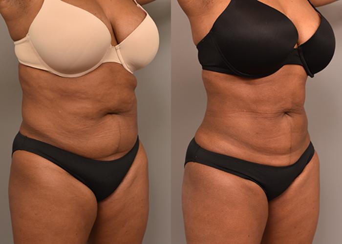 Before & After Liposuction Case 232 View #2 View in New York, NY
