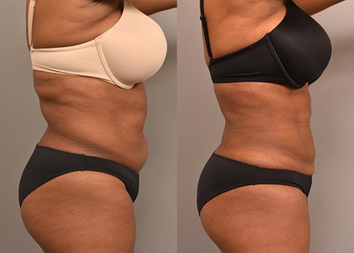 Before & After Liposuction Case 232 View #3 View in New York, NY