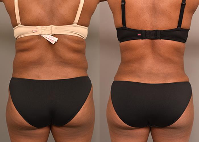 Before & After Liposuction Case 232 View #4 View in New York, NY