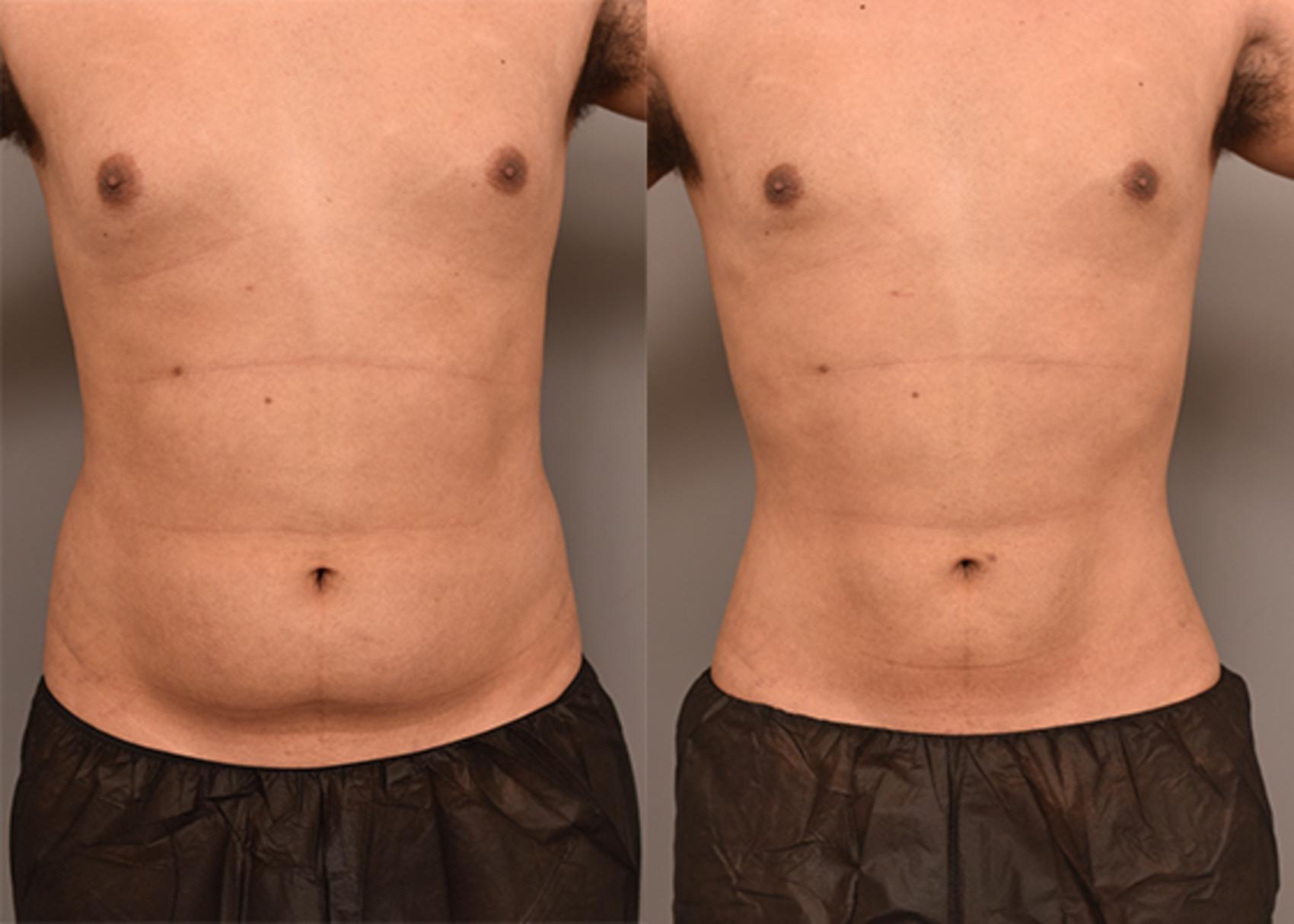 Before & After Liposuction Case 237 View #1 View in New York, NY