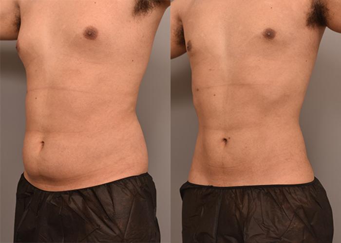 Before & After Liposuction for Men Case 237 View #2 View in New York, NY
