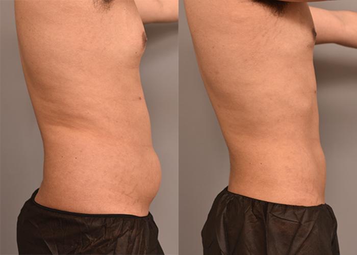Before & After Liposuction for Men Case 237 View #3 View in New York, NY