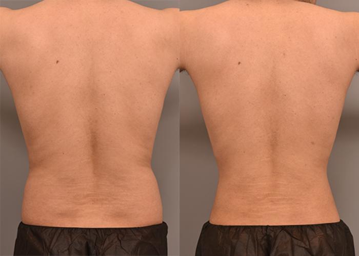 Before & After Liposuction for Men Case 237 View #4 View in New York, NY