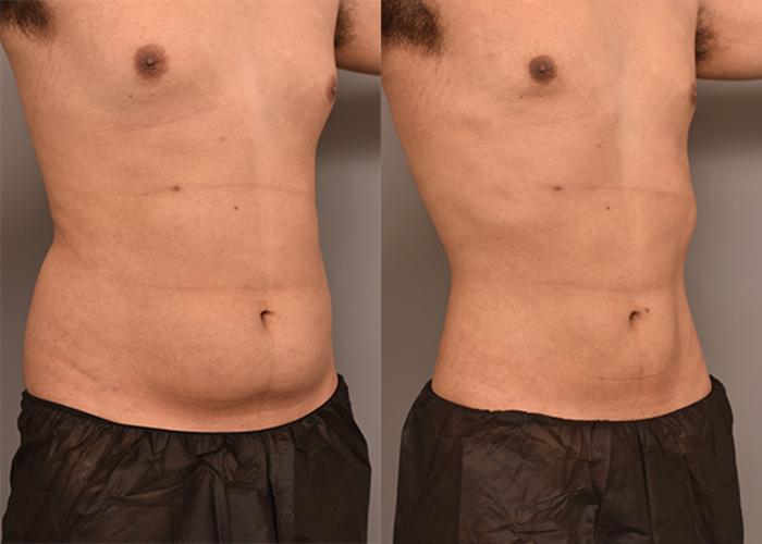 Before & After Liposuction for Men Case 237 View #5 View in New York, NY