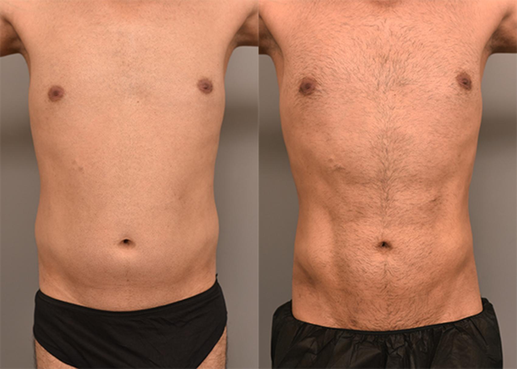 Before & After Liposuction Case 240 View #1 View in New York, NY