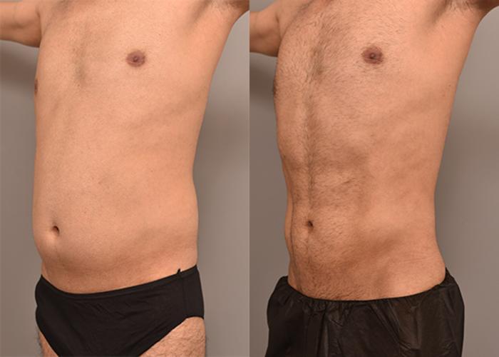 Before & After Liposuction Case 240 View #2 View in New York, NY