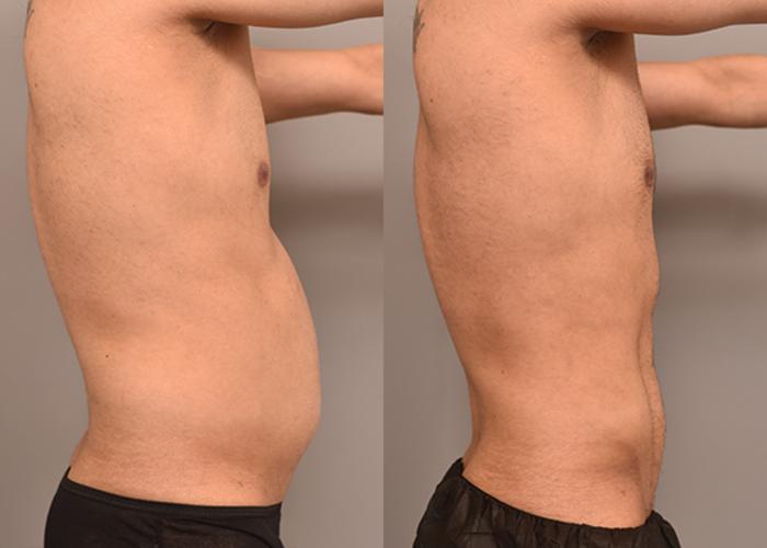 Before & After Liposuction Case 240 View #3 View in New York, NY