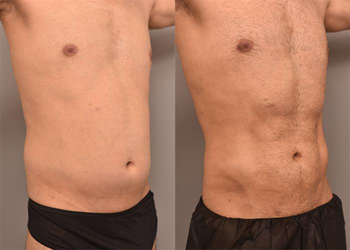 Before & After Liposuction Case 240 View #4 View in New York, NY