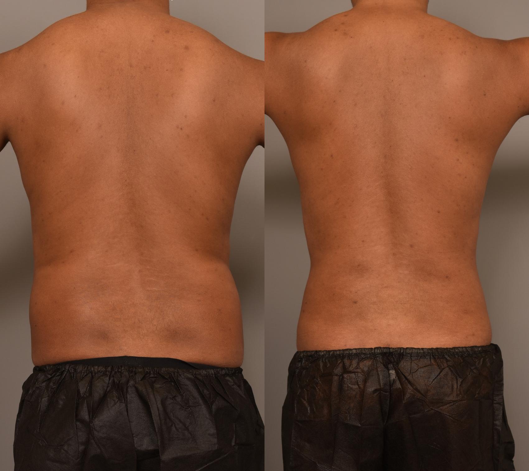 Before and after photos of a male patient who underwent 360-degree liposuction