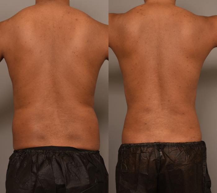 Before and after photos of a male patient who underwent 360-degree liposuction