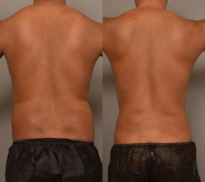 Before & After Liposuction Case 276 Back View in New York, NY