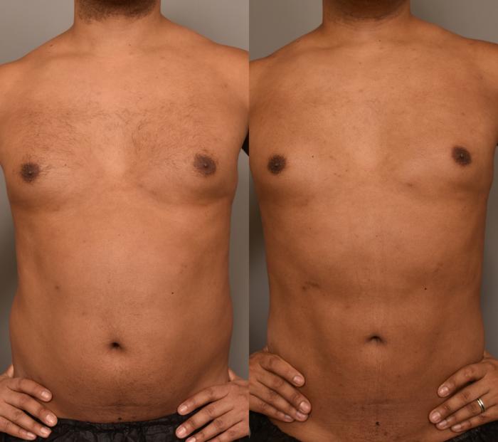 Before & After Liposuction Case 276 Front View in New York, NY