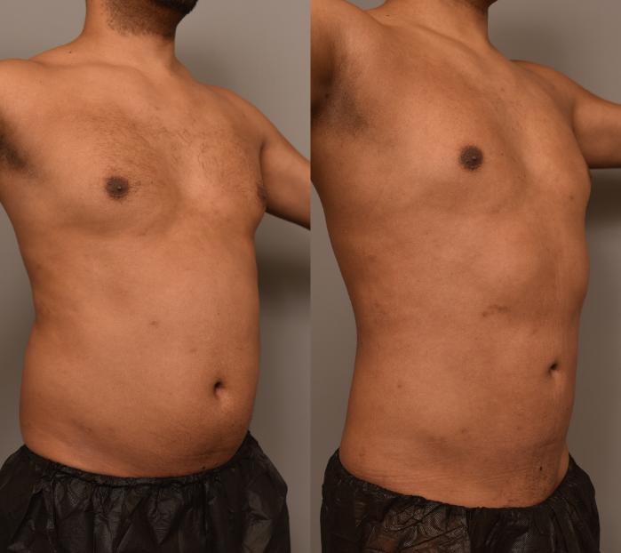 Before and after photos of a male patient who underwent 360-degree liposuction