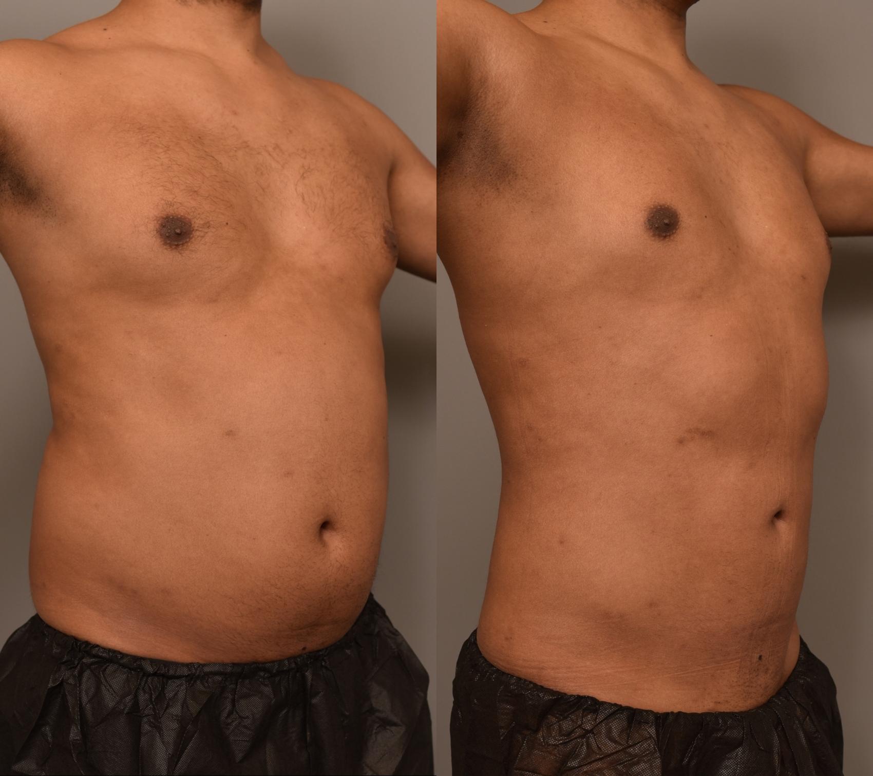 Before and after photos of a male patient who underwent 360-degree liposuction