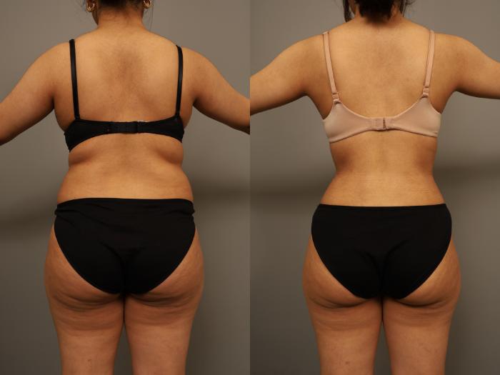 Before & After Liposuction Case 294 Back View in New York, NY