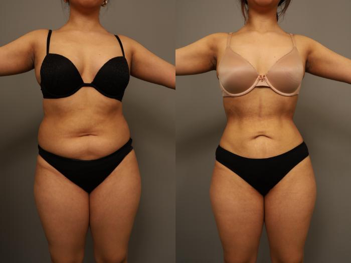 Before & After Liposuction Case 294 Front View in New York, NY