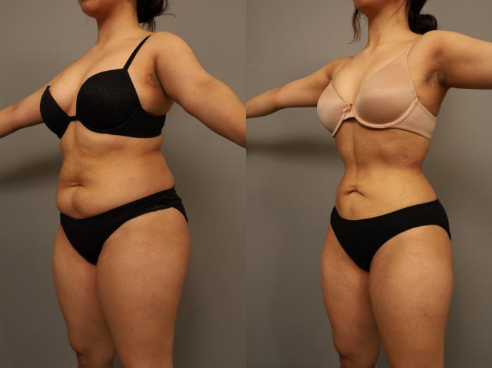 Before & After Liposuction Case 294 Left Oblique View in New York, NY