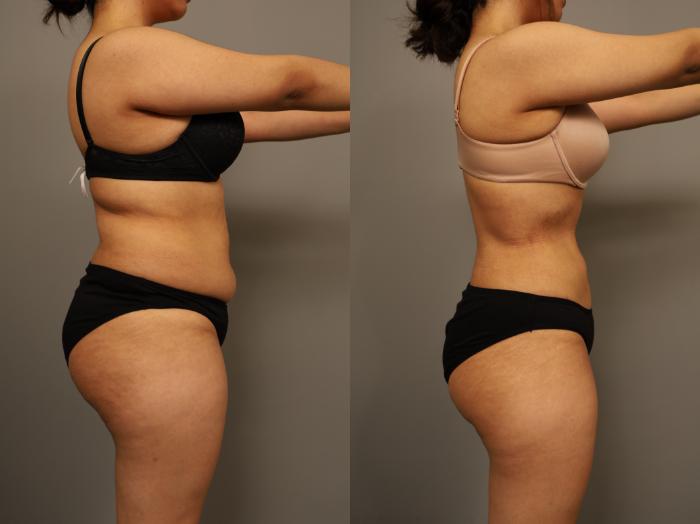 Before & After Liposuction Case 294 Left Side View in New York, NY