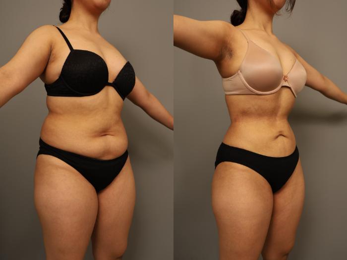 Before & After Liposuction Case 294 Right Oblique View in New York, NY