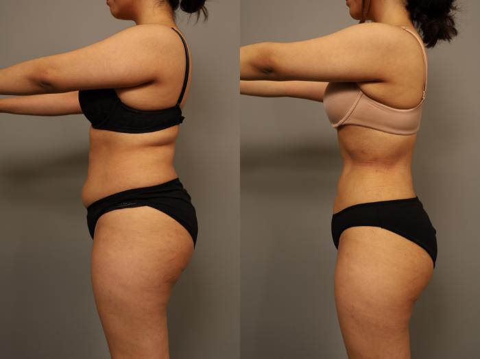 Before & After Liposuction Case 294 Right Side View in New York, NY