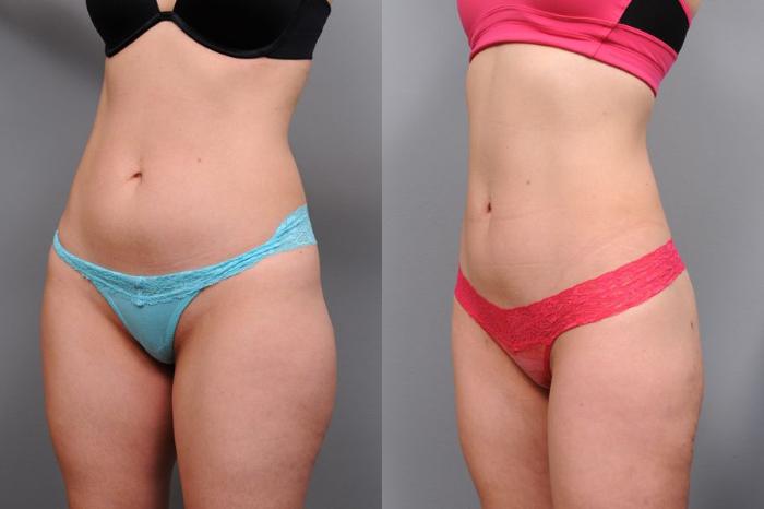 Smartlipo Flanks Liposuction for Women - Before & After Photos