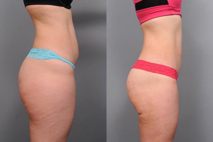 Smartlipo Liposuction Before After Photos Patient 35 NYC Dr