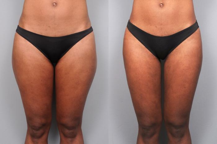 Smartlipo Liposuction Before After Photos Patient 36 NYC Dr