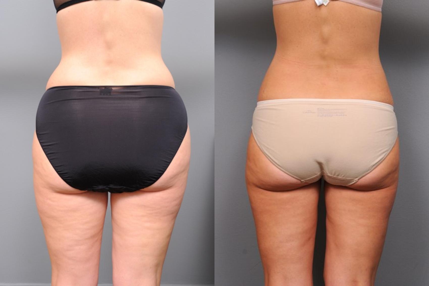 Smartlipo & Vaser for Snatched Waist & No More Love Handles! Before & After  Photos New Jersey - Reflections Center