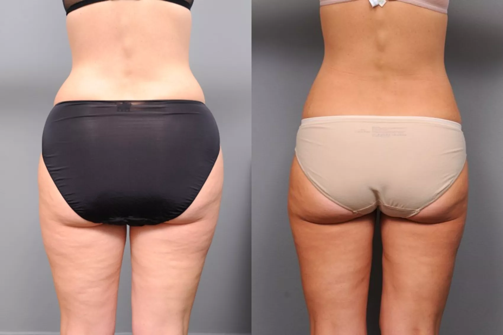 Smart Lipo Before and After Pictures Case 269