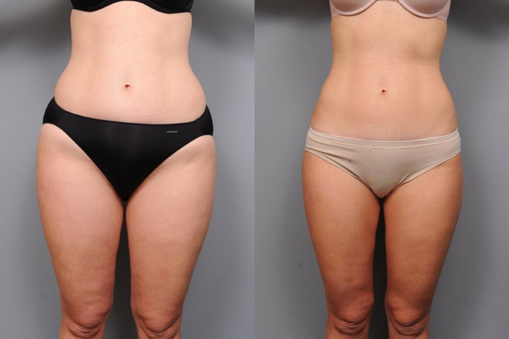 Before & After Liposuction Case 44 View #2 View in New York, NY