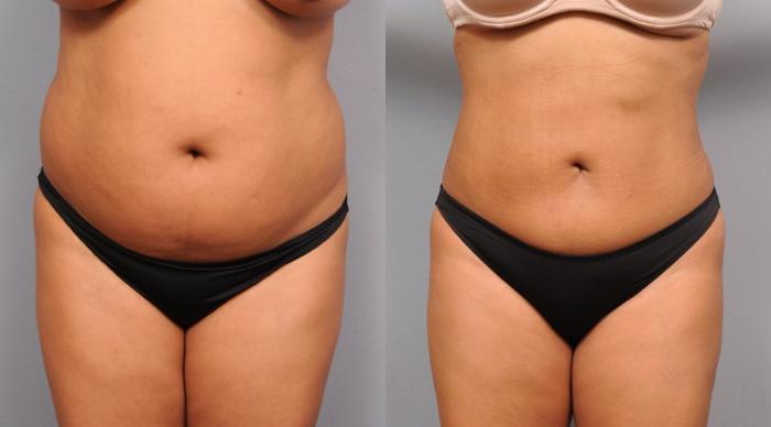 Before & After Liposuction Case 45 View #1 View in New York, NY