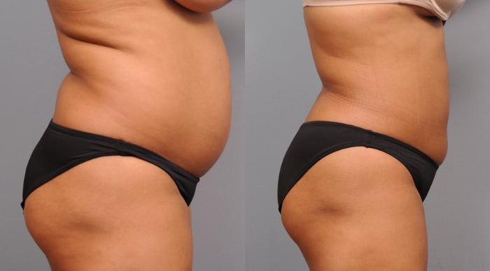 Before & After Liposuction Case 45 View #2 View in New York, NY