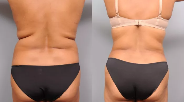 Smartlipo™ Liposuction Before & After Photos Patient 45, NYC