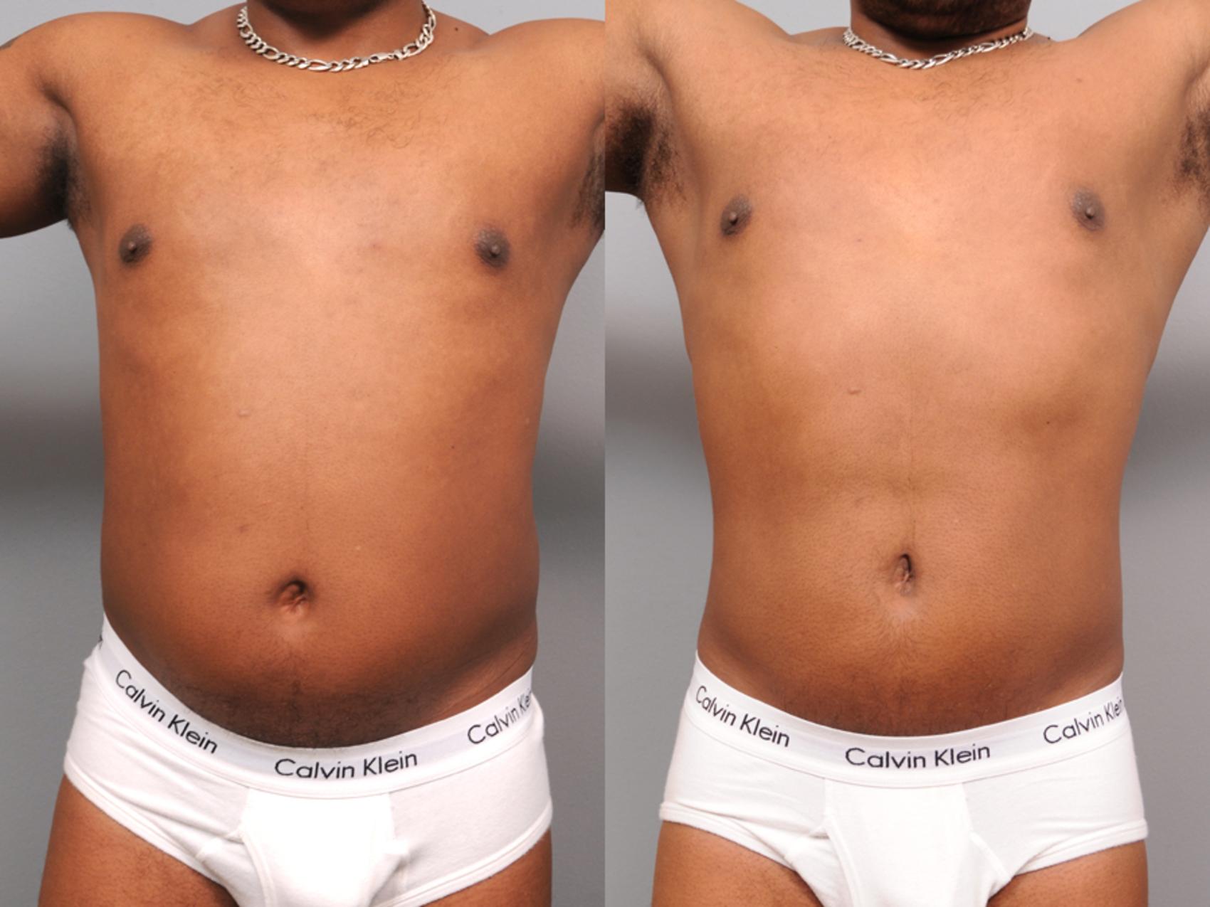 Before & After Liposuction Case 164 View #1 View in New York, NY