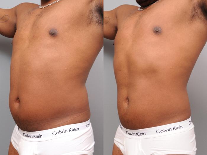Before & After Liposuction for Men Case 164 View #2 View in New York, NY