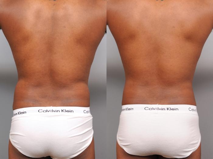 Before & After Liposuction for Men Case 164 View #3 View in New York, NY