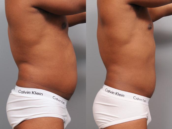 Before & After Liposuction for Men Case 164 View #4 View in New York, NY