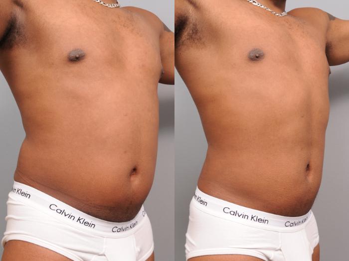 Before & After Liposuction for Men Case 164 View #5 View in New York, NY