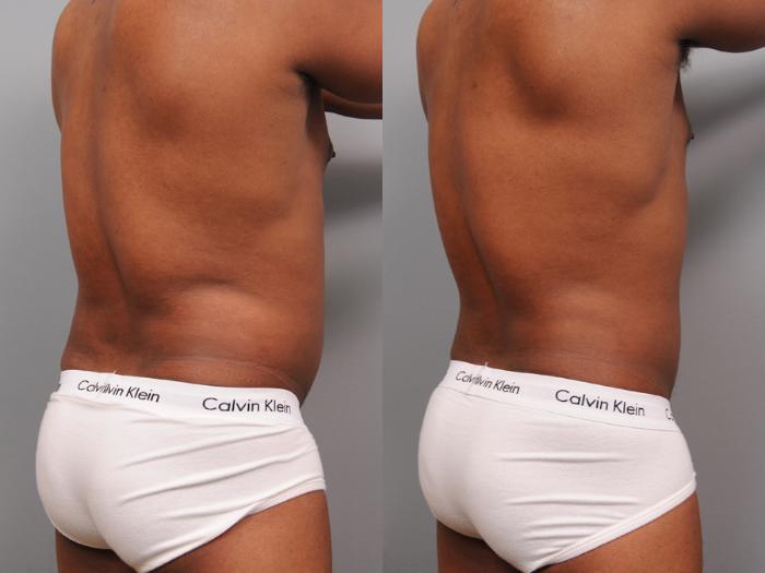 Before & After Liposuction for Men Case 164 View #6 View in New York, NY