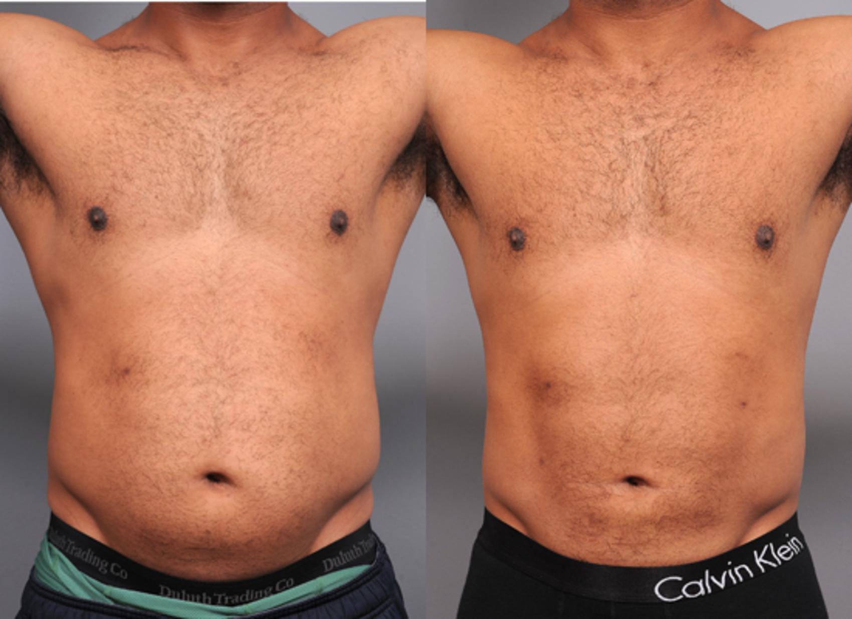 Before & After Liposuction Case 187 View #1 View in New York, NY