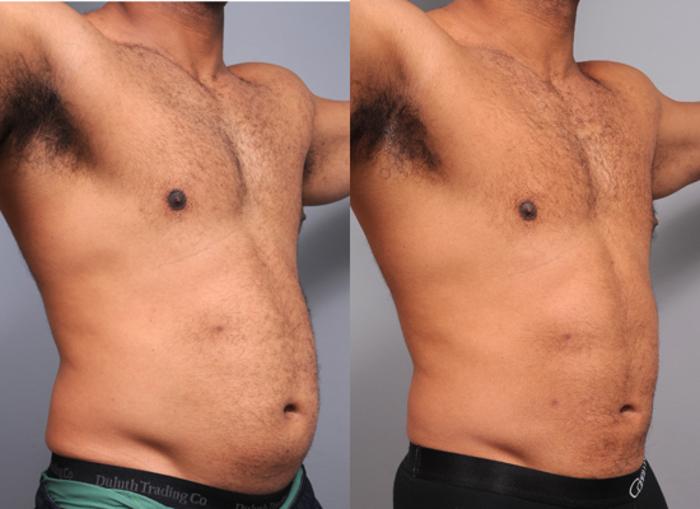 Before & After Liposuction for Men Case 187 View #2 View in New York, NY