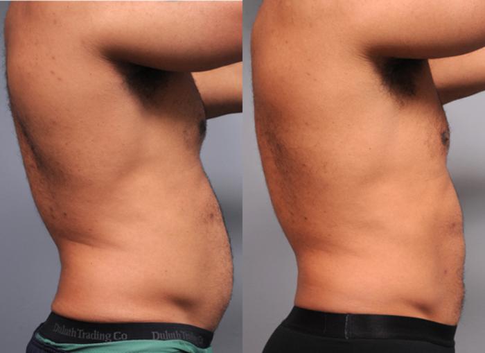 Before & After Liposuction for Men Case 187 View #3 View in New York, NY
