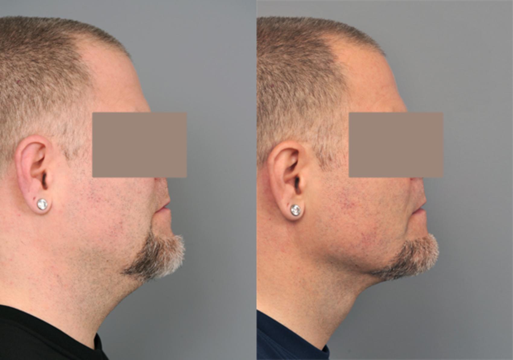 Before & After Neck Liposuction / Chin Liposuction  Case 202 View #1 View in New York, NY