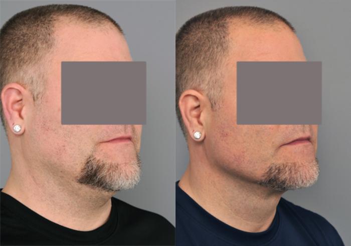 Before & After Liposuction for Men Case 202 View #2 View in New York, NY