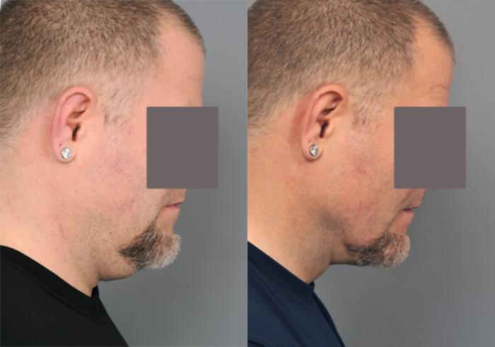 Before & After Neck Liposuction / Chin Liposuction  Case 202 View #3 View in New York, NY